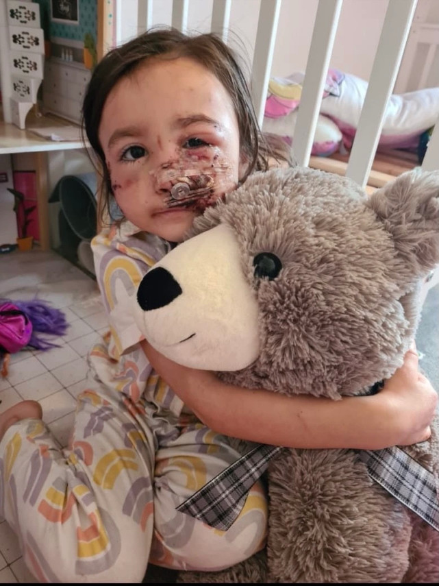 英国5岁女孩被邻居家斗牛犬撕去脸上大片肌肉,手术三次,不敢出门