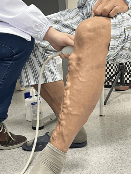 烧烤摊一做20年,老爹爹蚯蚓腿盘踞如树根,半小时后"换腿"!