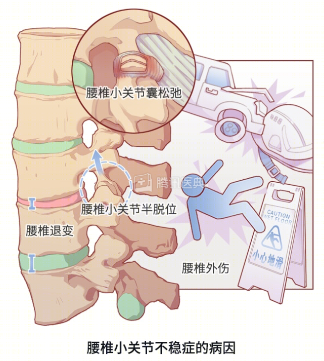 腰椎小关节脱位图片