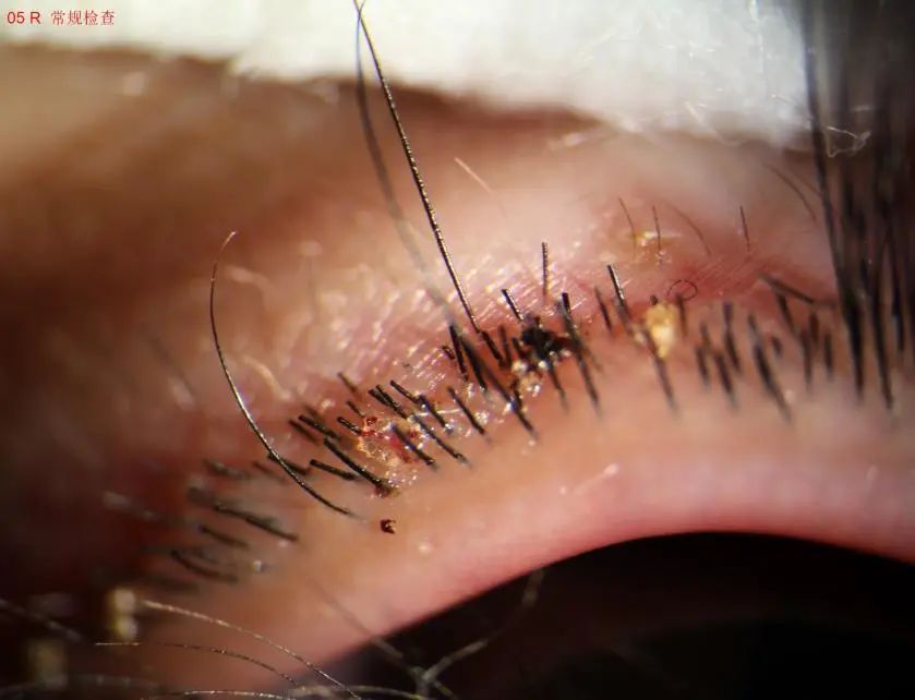 及棕黑色虫卵样物发现孩子睫毛处有透明虫体最终在裂隙灯显微镜下检查