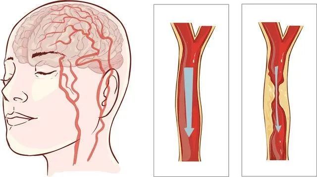 注意中风8个前兆症状，避免9大常见误区_腾讯新闻