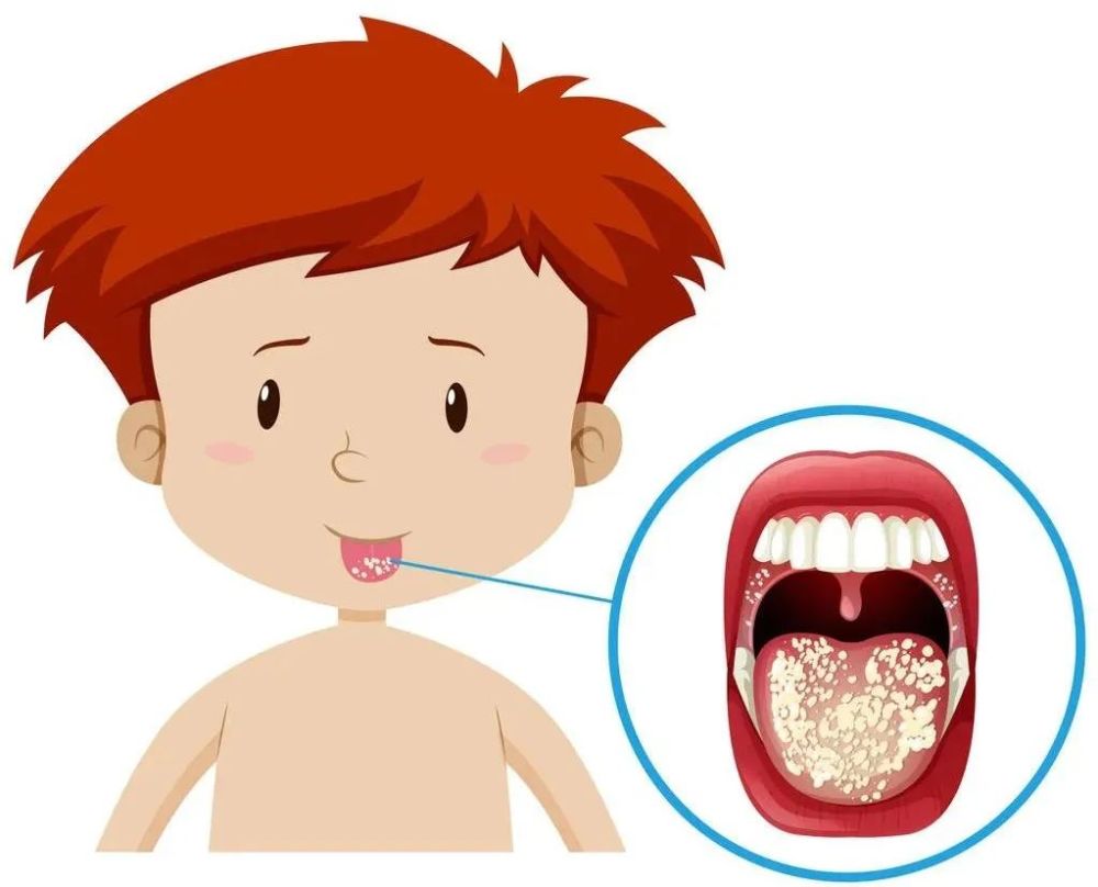 輕則無症狀,重則拒奶發熱,小兒鵝口瘡到底怎麼治?_騰訊新聞