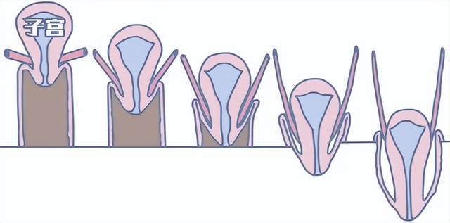 86岁奶奶子宫总是偷偷"溜"出来,阴道封闭术解决"难言之隐"_腾讯新闻