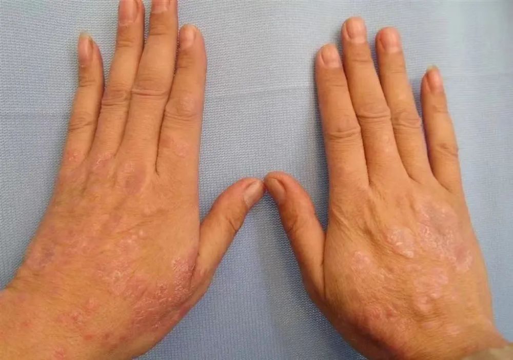 "牛皮癣"如何治疗?来听中医专家怎么说_腾讯新闻