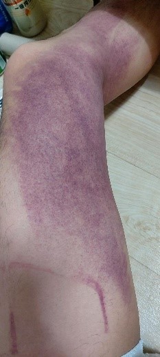 照片中,可以看到他的双腿从大腿到脚踝都淤血严重,特别是左大腿内侧