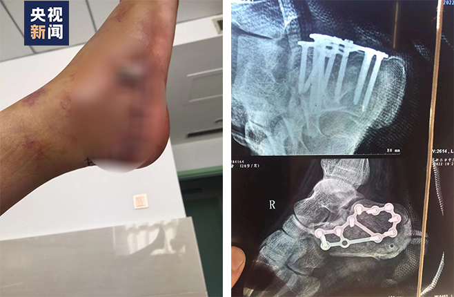 脚踝手术铆钉图片