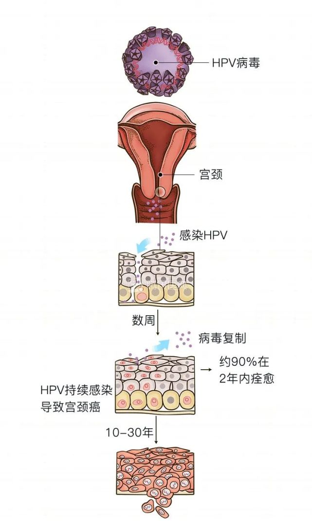 宫颈炎会变成"宫颈糜烂"吗?这 3 种情况不用治