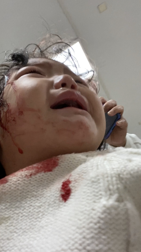 女星张兆艺厕所玻璃炸裂!孩子头破血流沾满上衣,老公脸部被划伤