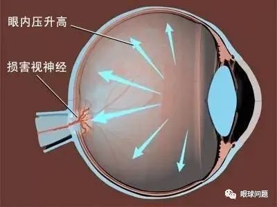 北京仁爱堂如何治疗青光眼？新东方和考虫考研哪个好