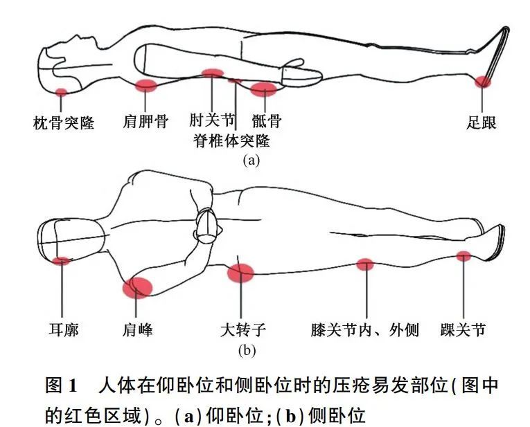 比如下圖是人體仰臥位或者側臥位是的壓瘡易發部位