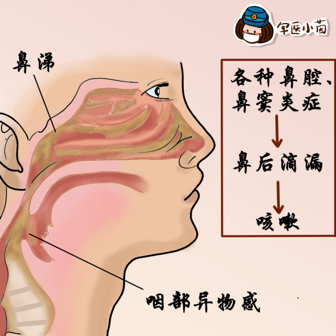 鼻后滴漏综合症 腾讯网