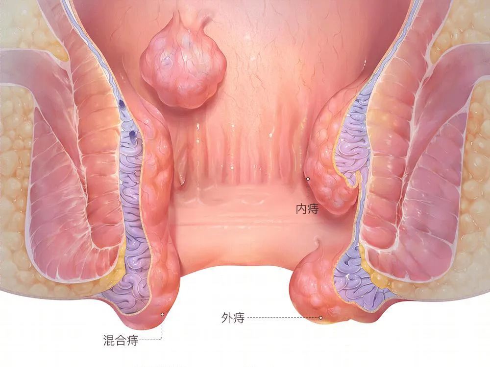 導致裂痔02肛裂久拖不治,可伴肛乳頭肥大,哨兵痔等疾病出現,嚴重的會