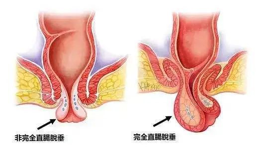 軟的,手指一頂回去了肛門掉出一坨肉球