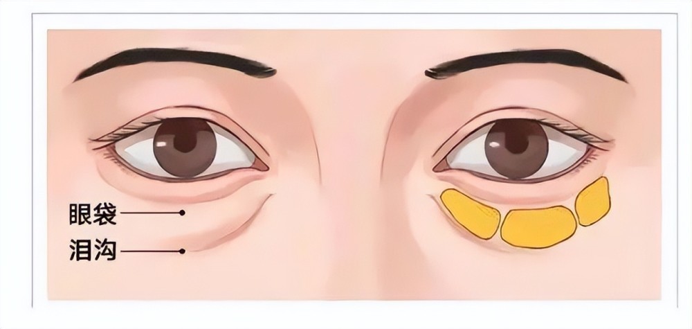 结构型的黑眼圈分为先天性和后天性,先天性原因主要是泪槽( tear