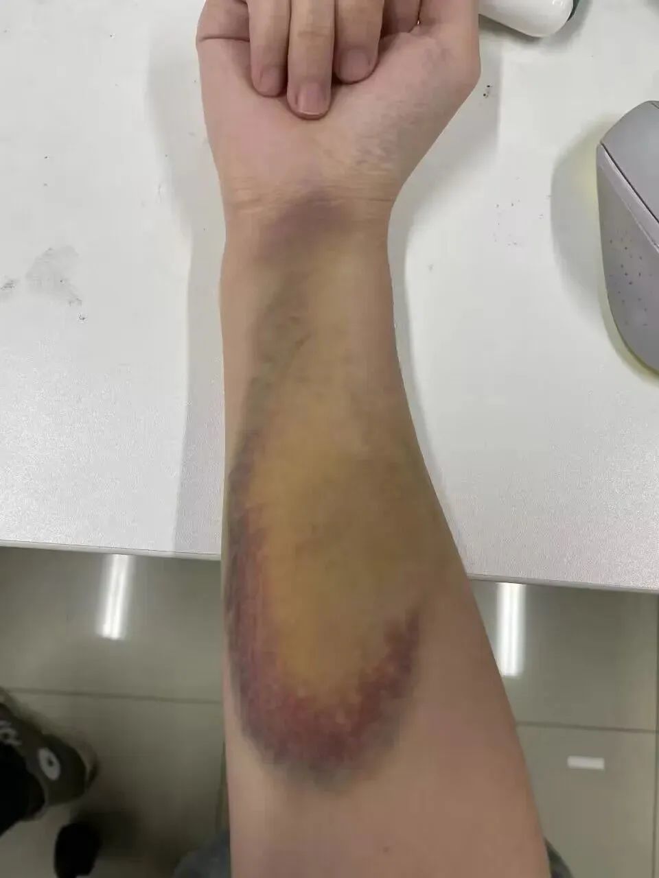 为救轻生女孩,这名研究生胳膊被咬出淤青!还好……_腾讯新闻