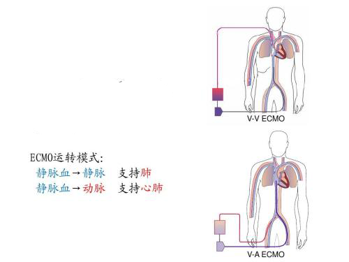 ecmo系统示意图图片