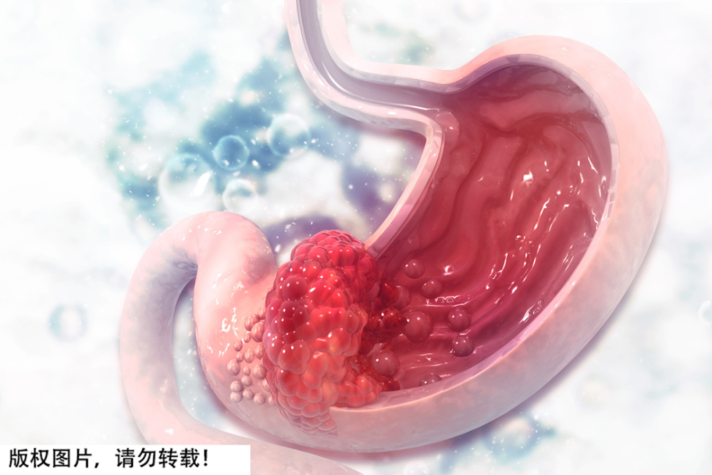 复旦大学附属肿瘤医院胃外科主任医师王亚农表示,一旦饮食不太健康