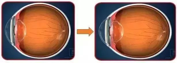 重视孩子的远视储备和眼轴长度，可以有效预防近视插图