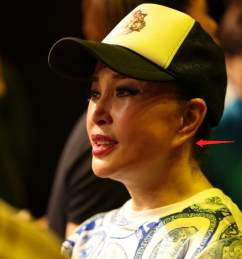 耳垂变形,满脸是坑,从刘晓庆到伊能静,明星拉皮后遗症太恐怖