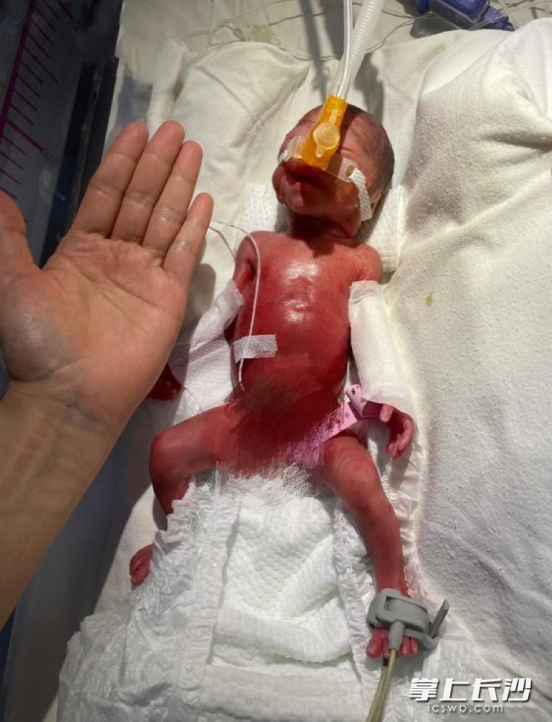 出生体重650克与成人手掌一般大小超早产双胞胎满百日了