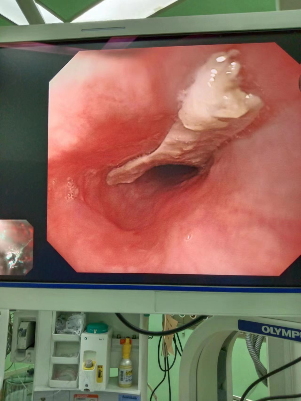 内镜下紧贴食管壁的鸭骨头丨作者供图又等待了将近两个小时,消杀完毕