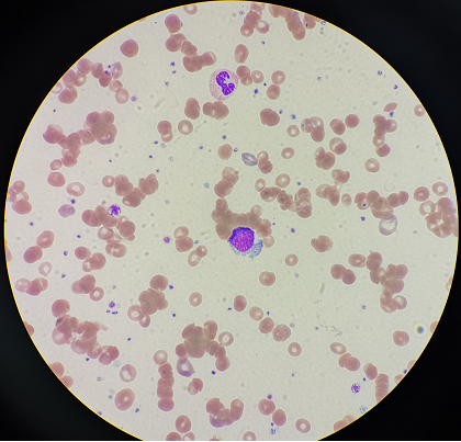 我们显微镜下见分晓,血涂片确实可以看到红细胞凝集现象,如图4图3本例