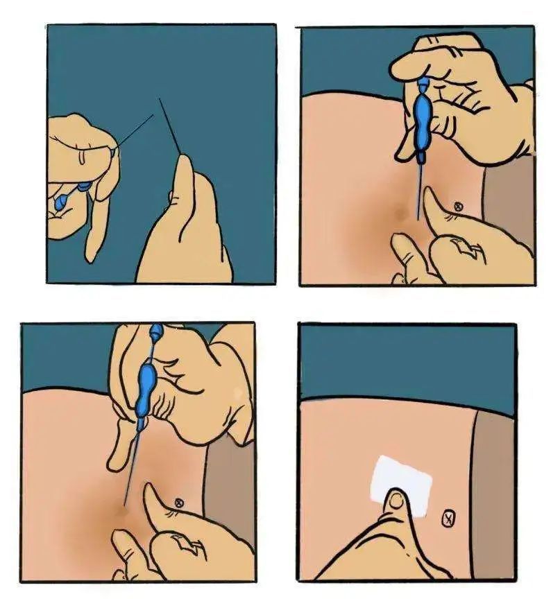 減肥手術哪種效果好_減肥手術有什么危害_手術減肥