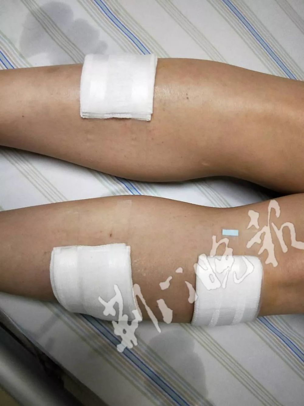 減肥手術哪種效果好_減肥手術有什么危害_手術減肥