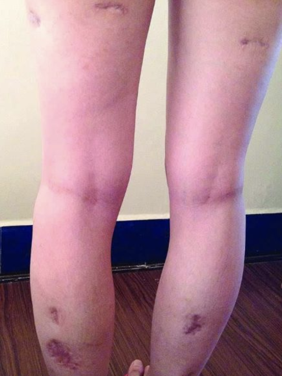 減肥手術哪種效果好_手術減肥_減肥手術有什么危害