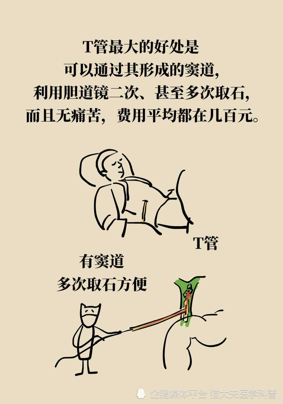 什么是oddi括约肌为什么医生越来越重视oddi括约肌功能的保护