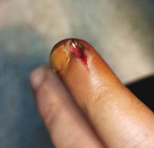 男子手撕倒刺感染 手指差点不保