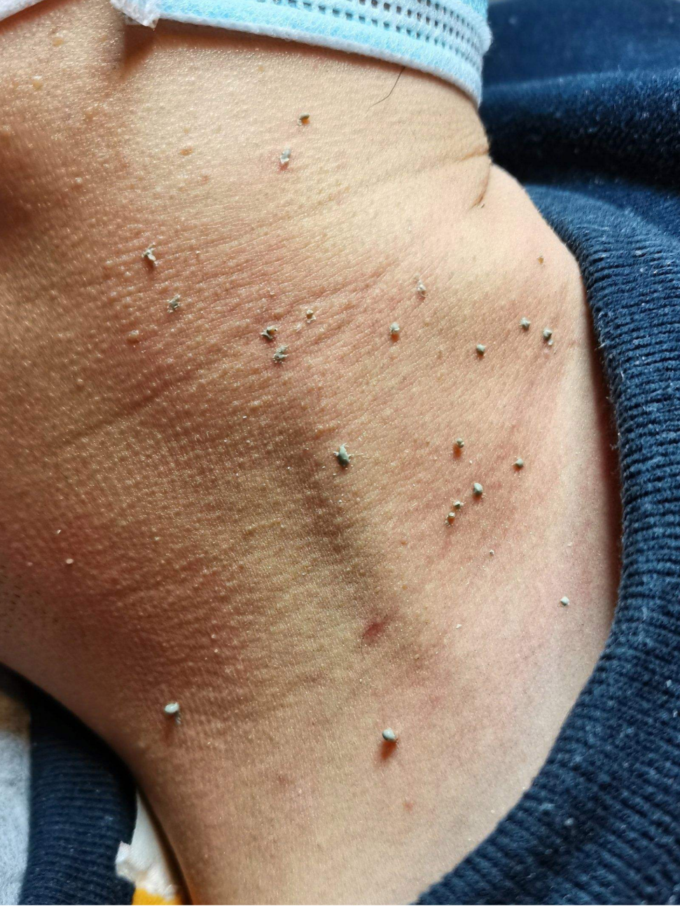 祛除瘊子,眼子,用对方法很重要_腾讯新闻