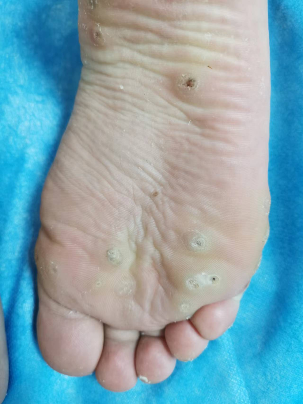 祛除瘊子,眼子,用对方法很重要_腾讯新闻