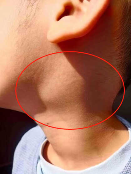 "23日11时56分,李先生在求助中表示,儿子的喉咙在做过微创手术后出现