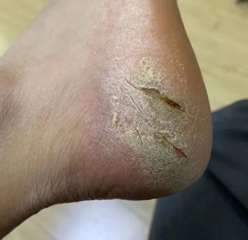 为啥越来越多人出现脚后跟干裂?3个习惯正在吞噬你,改改吧!_腾讯新闻