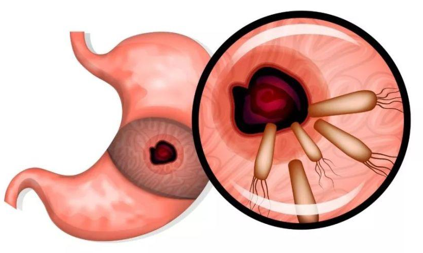 幽门螺杆菌是胃癌最大的祸根劝告不想惹上胃癌2种食物尽早撤下餐桌