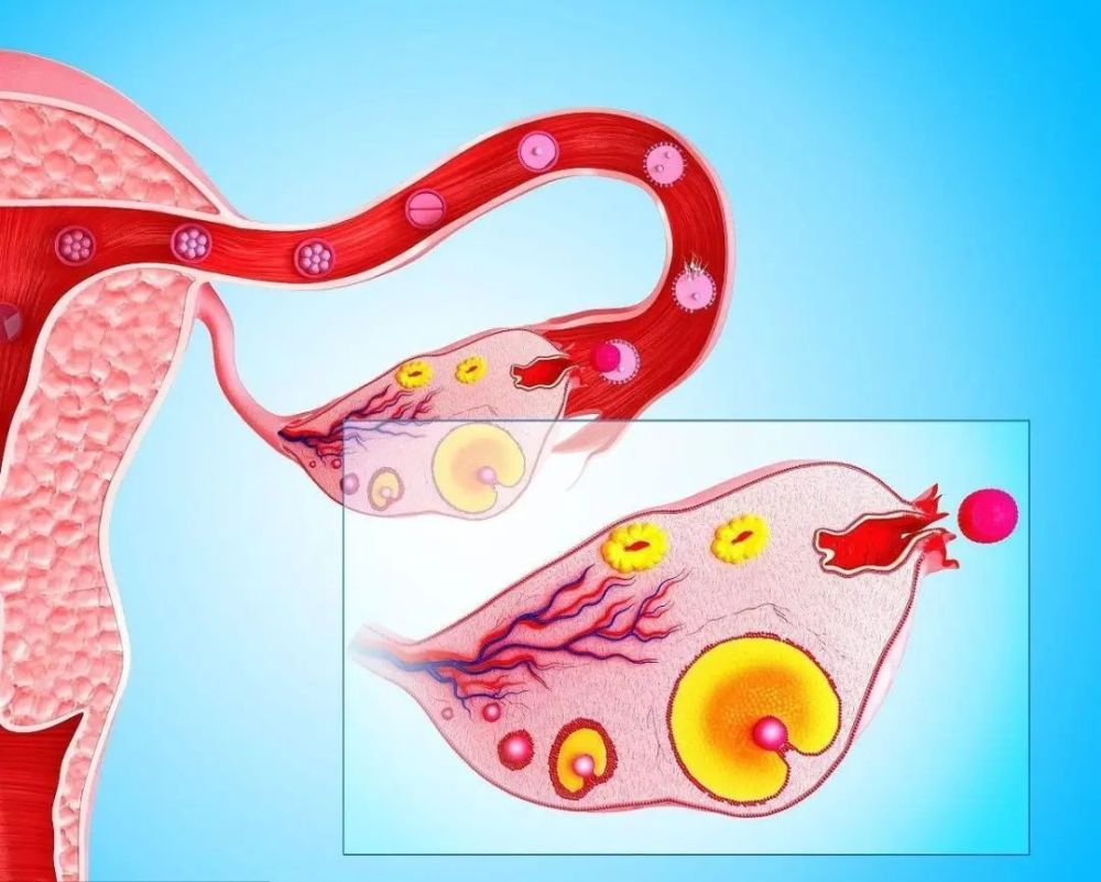 卵巢癌無創診斷新發現brca1甲基化或可作為卵巢癌輔助診斷指標