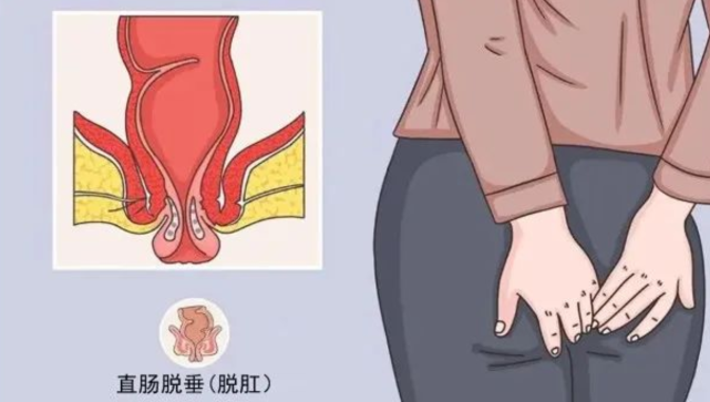 药大学第二附属医院)肛肠四科后,考虑到儿童的直肠全层脱垂十分少见