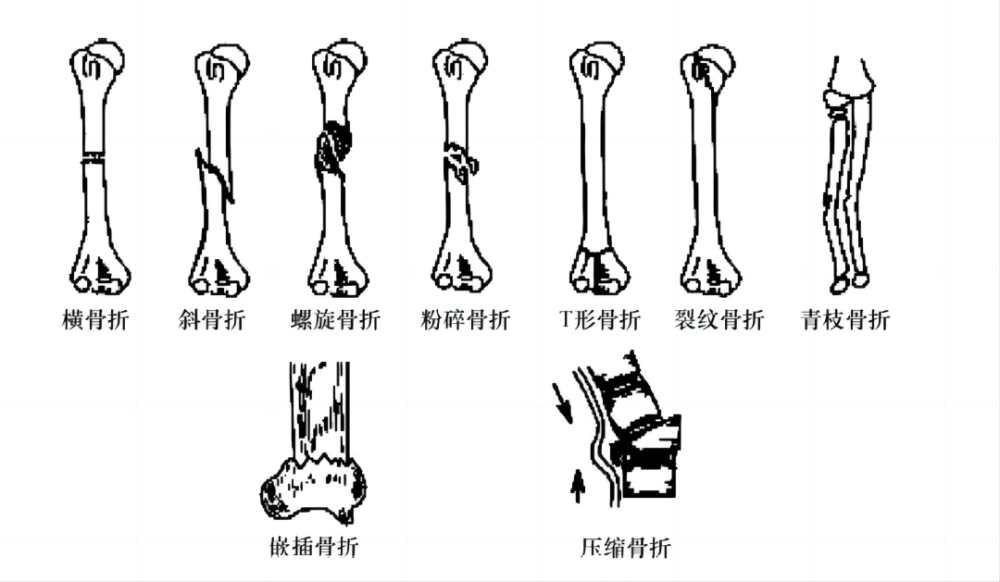 骨折如何确定伤残等级