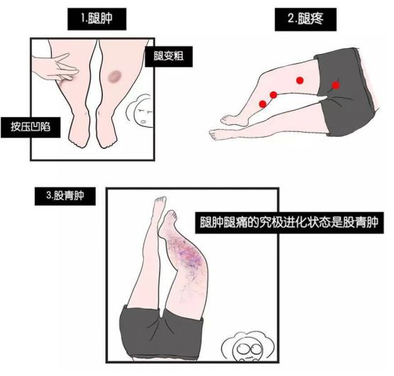 1,下肢深静脉血栓河南省肿瘤医院血液科副主任,主任医师周虎表示,要