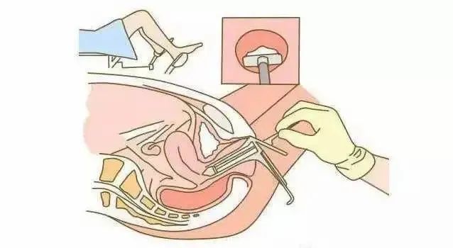 tct提示中度炎症需要治疗吗?_腾讯新闻_玉竹健康网