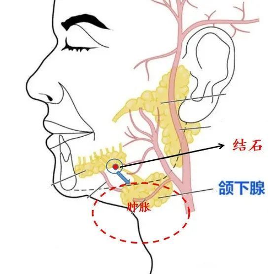 唾液腺导管堵塞图片图片