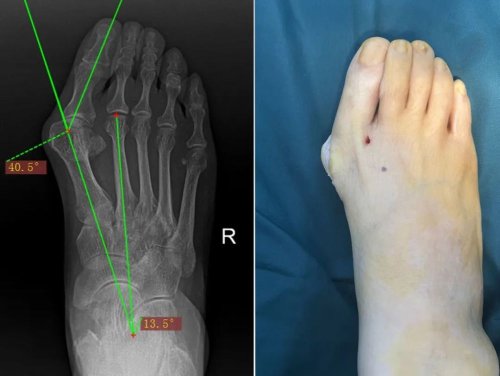 西安骨科醫院(西安仲德骨科醫院)拇外翻,是指拇趾在第一蹠趾關節處向