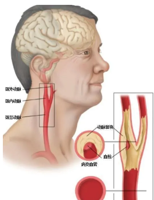 有頸動脈斑塊了怎麼辦?