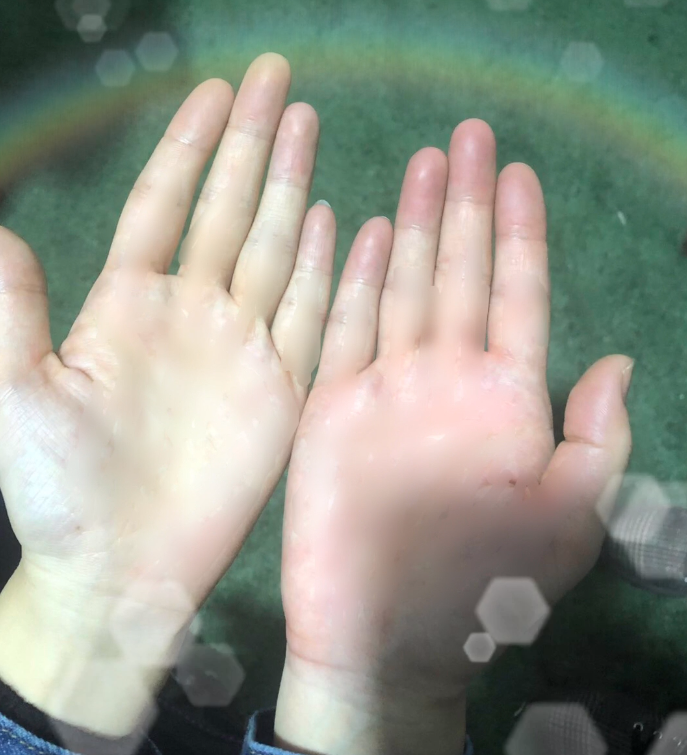 只见赵丽颖打人的右手掌,几乎比左边肿了一大圈,红肿半天没消下去