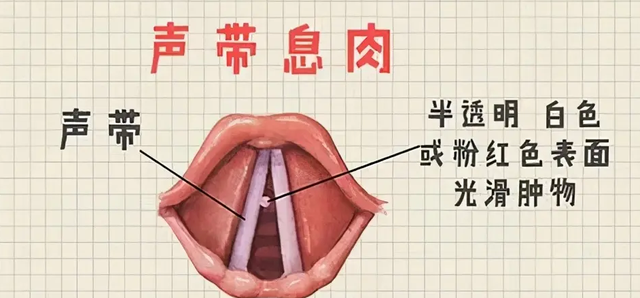 霞浦康明醫院喉嚨息肉是什麼症狀