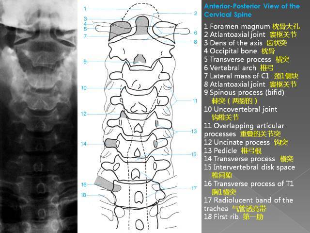 x线入门|详细的腰椎x线解剖 解读