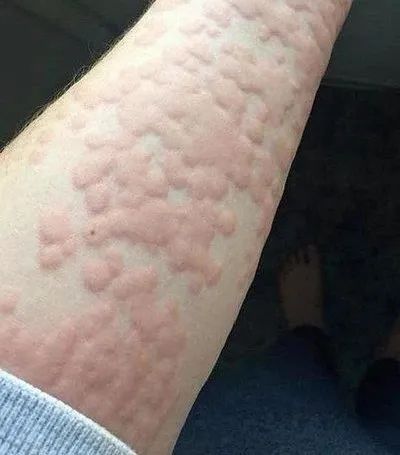 荨麻疹初期症状图片