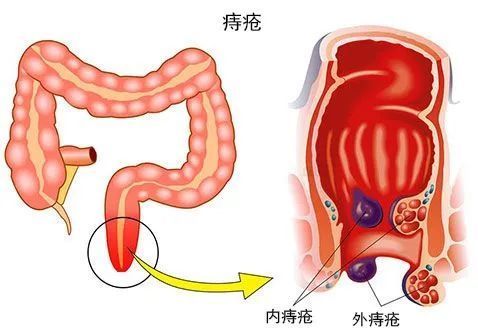 抑 菌 凝 胶,涂好后静静的等一会,让痔疮膏充分吸收,涂上一阵子肉球