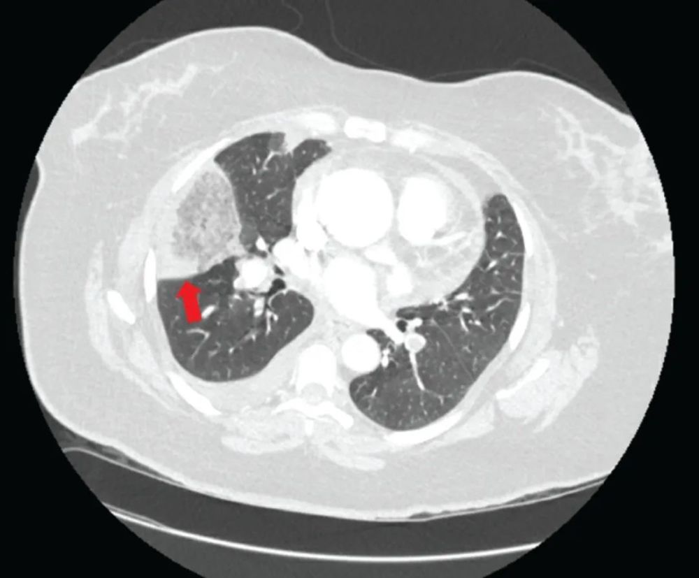 驼峰征肺梗死与肺栓塞是什么关系